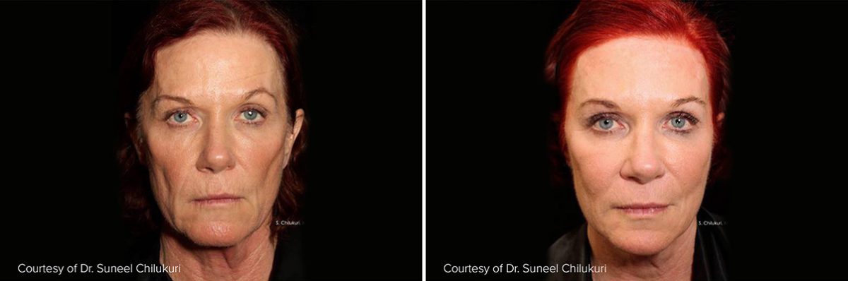 Thread Lift Services In Madison & Milwaukee, Before and After Photos Thread Lift Before and After Photos in Mequon, WI, Patient 17527