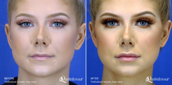 Juvéderm® Before and After Photos in Delafield, WI, Patient 17531