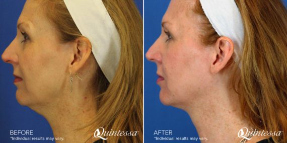 Kybella® Before and After Photos in Delafield, WI, Patient 17538