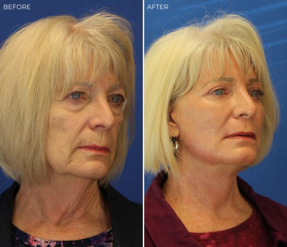 Laser Skin Resurfacing Before and After Photos in Delafield, WI, Patient 17546