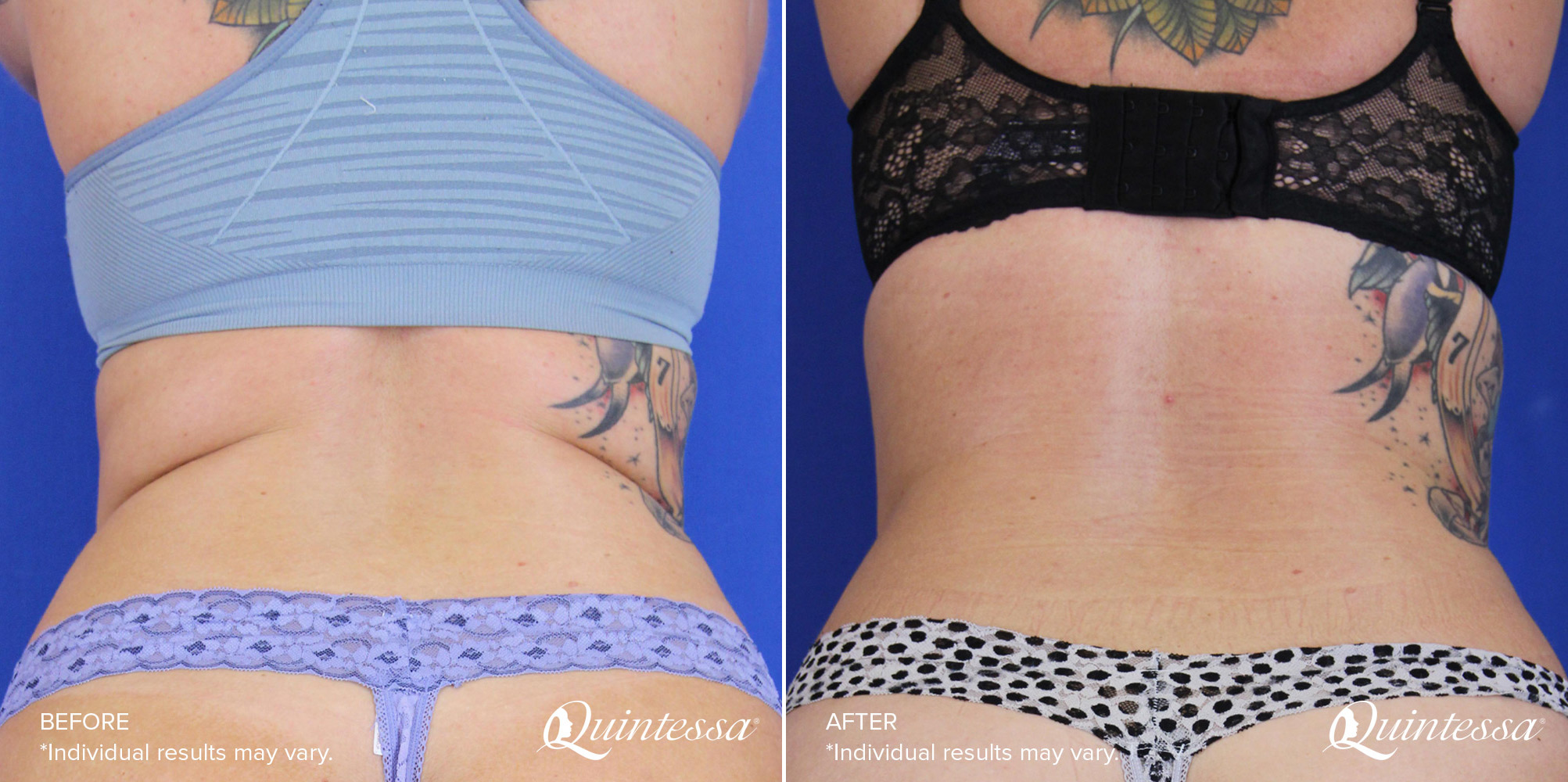 Coolsculpting the flanks – before & after
