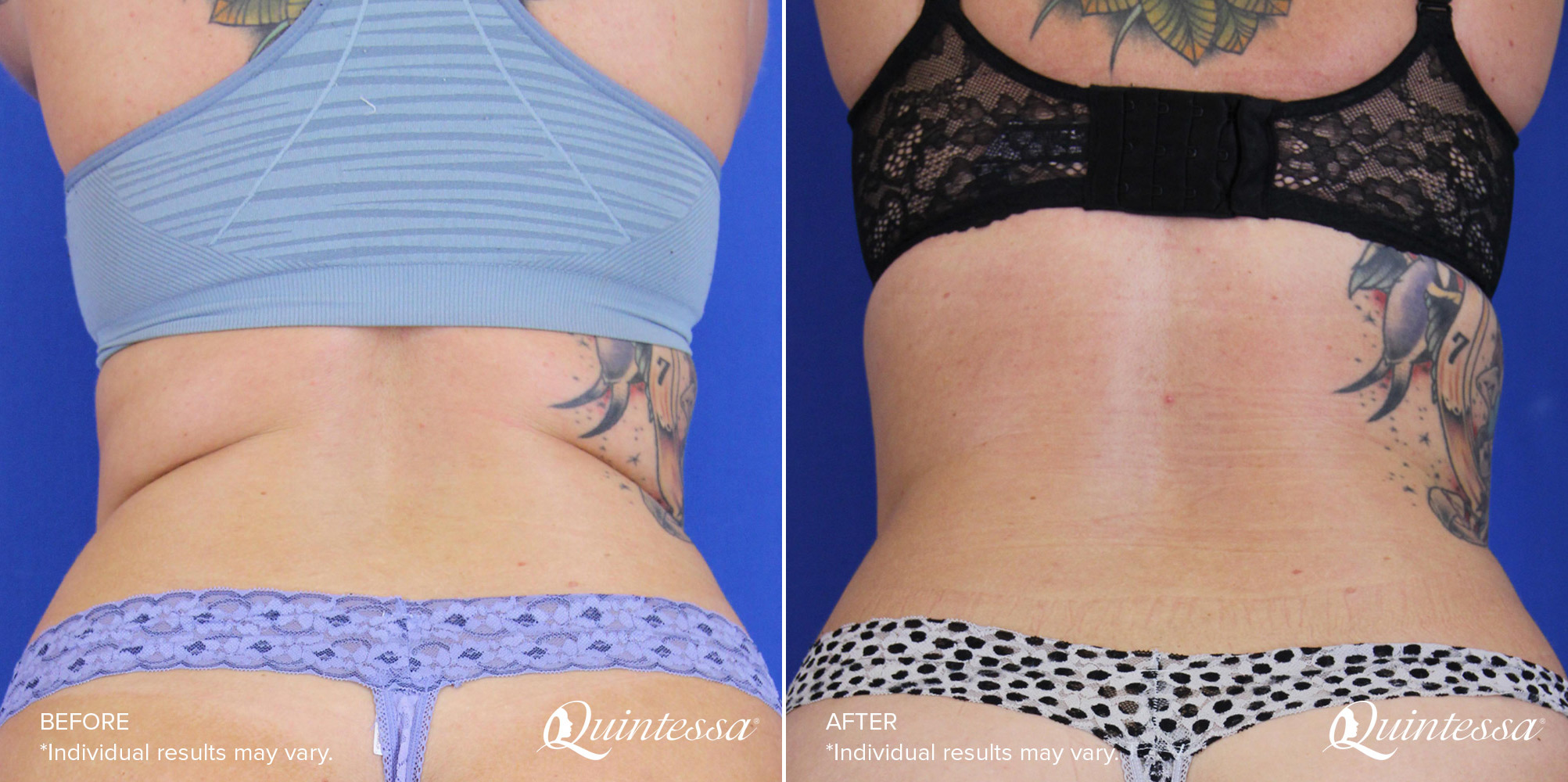 CoolSculpting - Flanks and Bra Strap Area Before & After Gallery - Case 4432