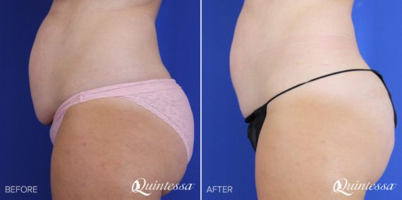 Coolsculpting Before and After Photos in Mequon, WI, Patient 17561