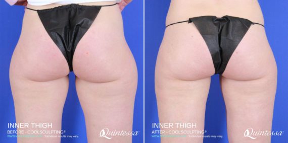 Coolsculpting Before and After Photos in Mequon, WI, Patient 17566