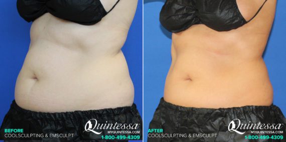 Coolsculpting Before and After Photos in Madison, WI, Patient 17570