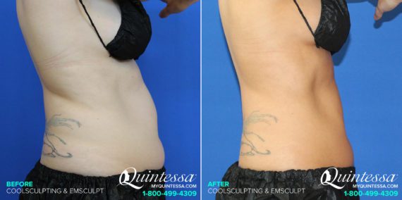 Coolsculpting Before and After Photos in Madison, WI, Patient 17570