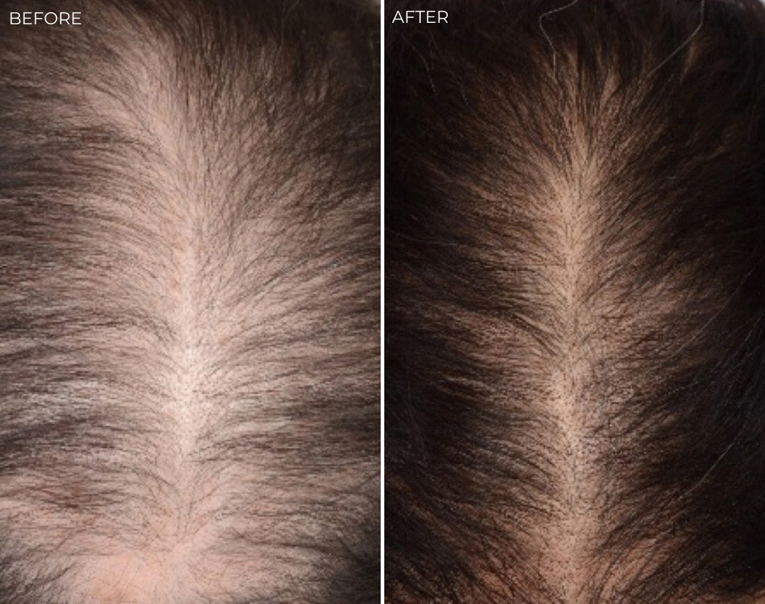 PRP Hair Restoration Before and After Photos in Delafield, WI, Patient 17577