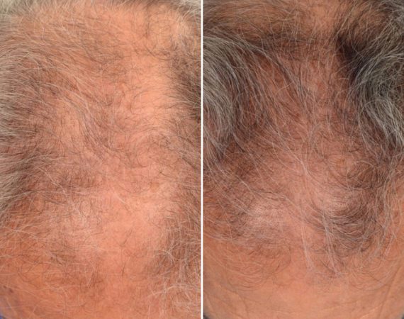 PRP Hair Restoration Before and After Photos in Delafield, WI, Patient 17581