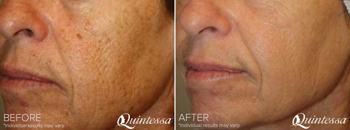 BBL Laser Facial Before and After Photos in Madison, WI, Patient 17585