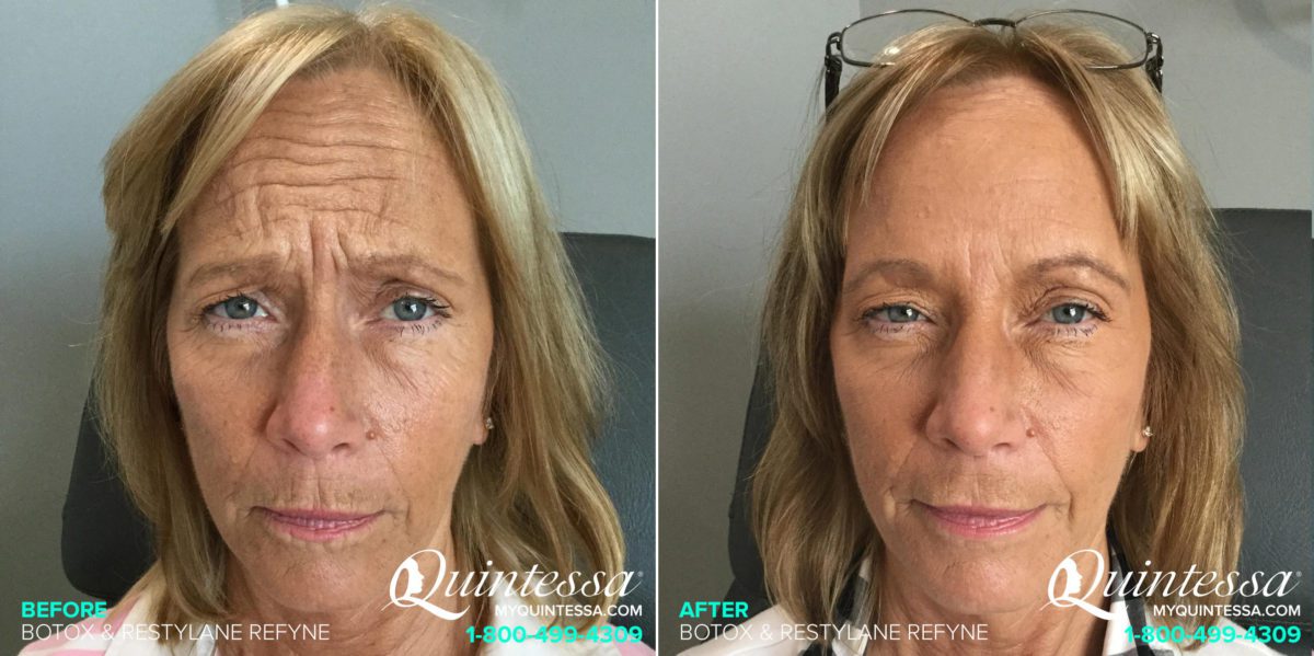 Botox Before and After Photos in Delafield, WI, Patient 17593