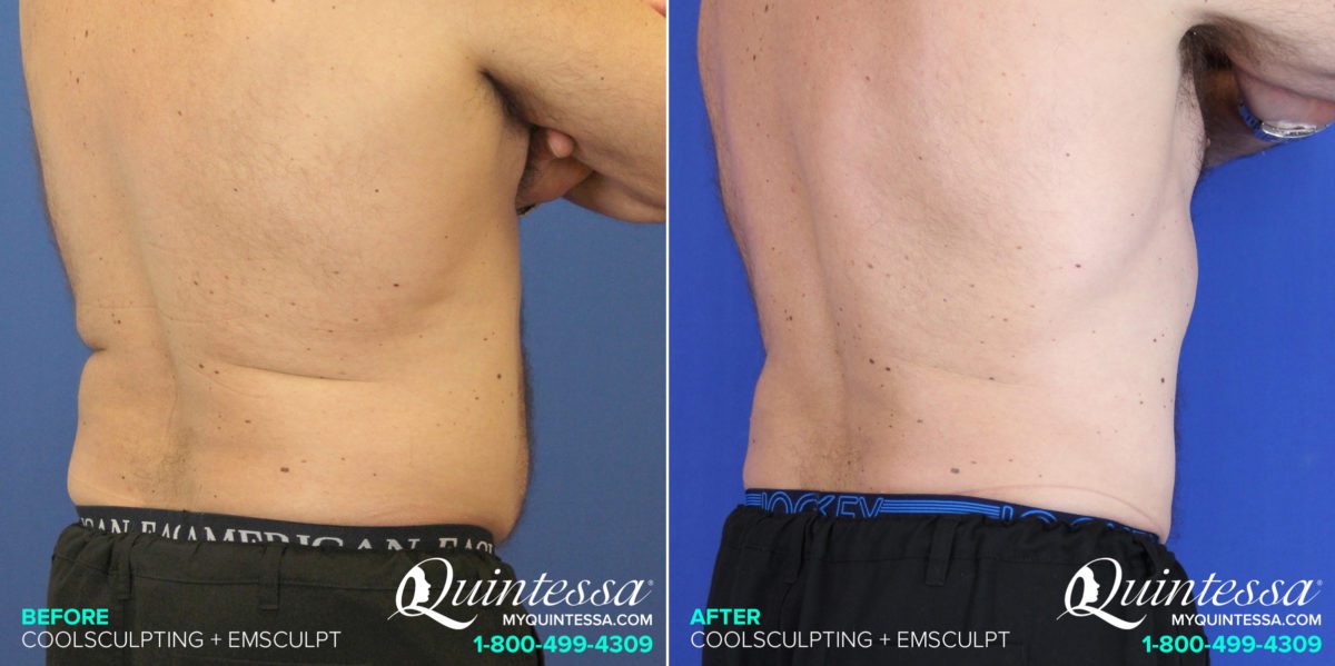 Coolsculpting Before and After Photos in Madison, WI, Patient 17597