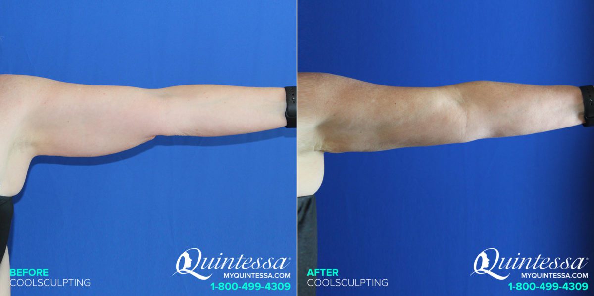 Coolsculpting Before and After Photos in Mequon, WI, Patient 17601