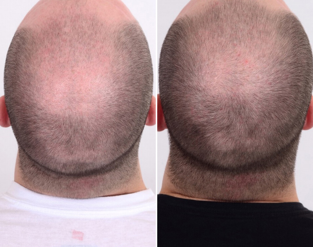PRP Hair Restoration Before and After Photos in Delafield, WI, Patient 17606