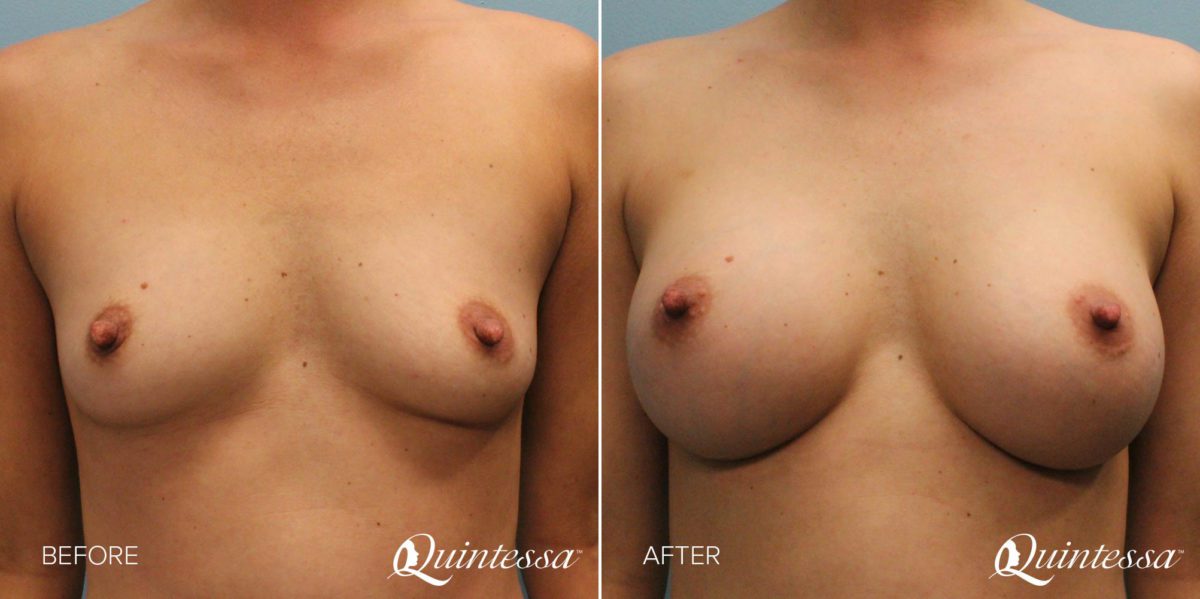 Breast Augmentation Before and After Photos in Delafield, WI, Patient 17617