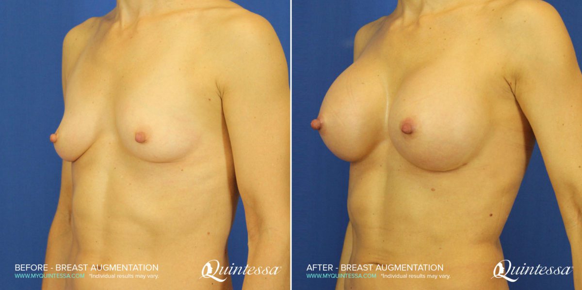 Breast Augmentation Before and After Photos in Delafield, WI, Patient 17624