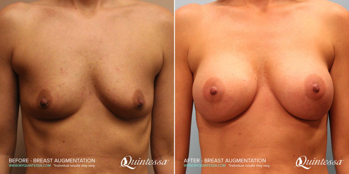 Breast Augmentation Before and After Photos in Delafield, WI, Patient 17632