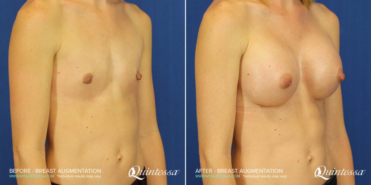 Breast Augmentation Before and After Photos in Delafield, WI, Patient 17646