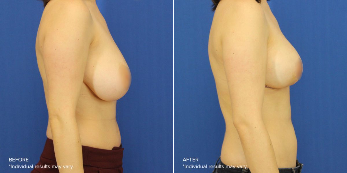 Breast Reduction Before and After Photos in Delafield, WI, Patient 17659