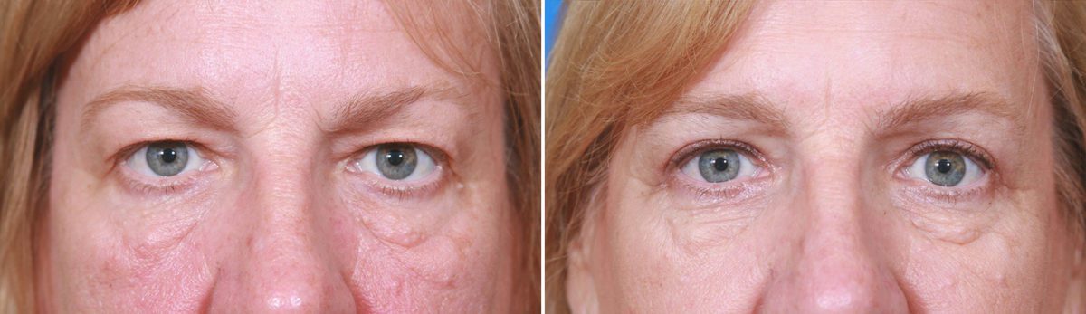 Eyelid Surgery Before and After Photos in Mequon, WI, Patient 17946