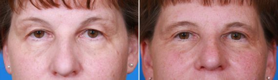Eyelid Surgery Before and After Photos in Delafield, WI, Patient 17950