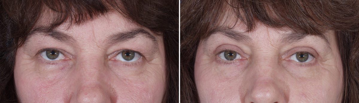 Eyelid Surgery Before and After Photos in Delafield, WI, Patient 17954