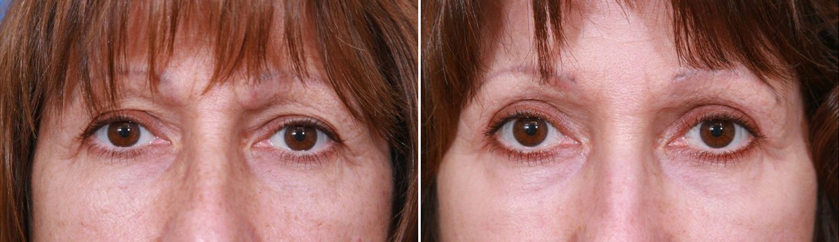 Eyelid Surgery Before and After Photos in Delafield, WI, Patient 17958