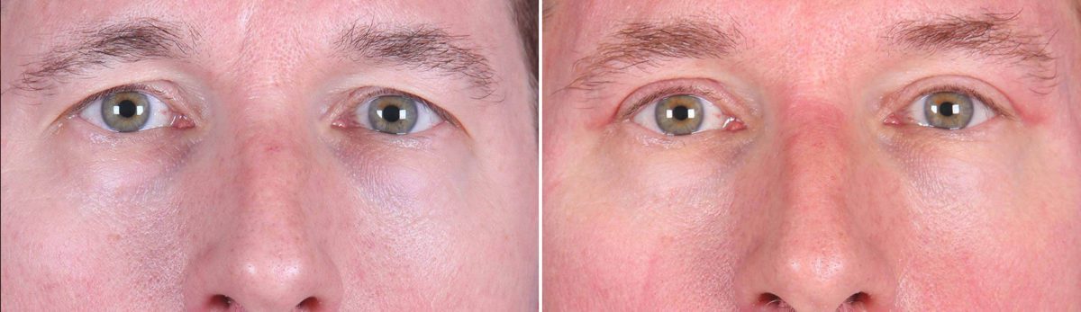 Eyelid Surgery Before and After Photos in Delafield, WI, Patient 17962