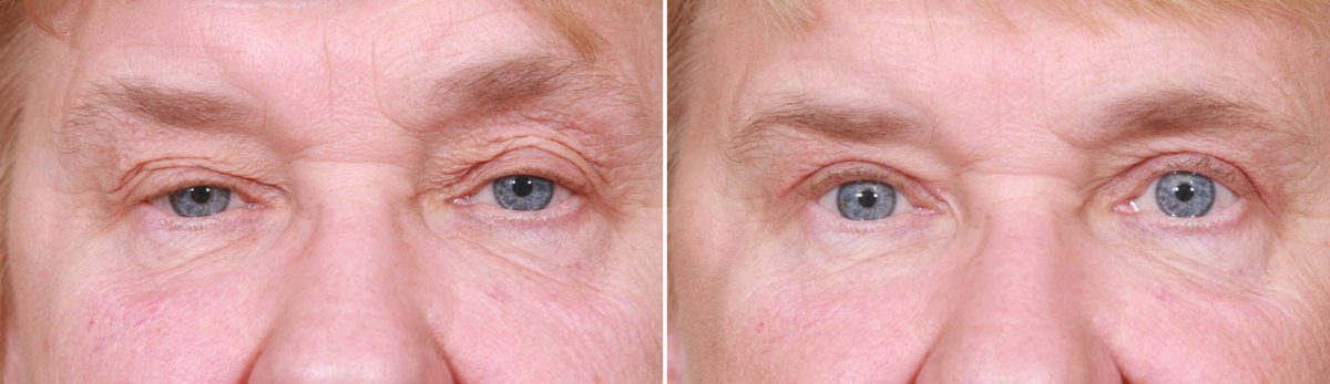 Eyelid Surgery Before and After Photos in Delafield, WI, Patient 17966