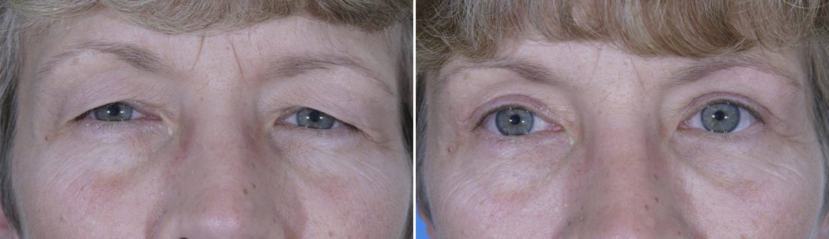 Eyelid Surgery Before and After Photos in Delafield, WI, Patient 17970