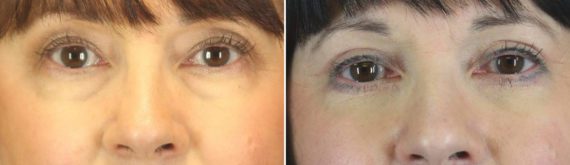 Eyelid Surgery Before and After Photos in Delafield, WI, Patient 17974