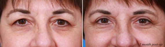 Eyelid Surgery Before and After Photos in Delafield, WI, Patient 17978