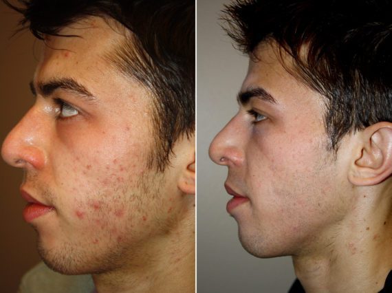 Halo Laser Before and After Photos in Delafield, WI, Patient 17984