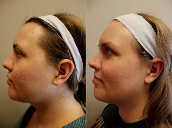 Halo Laser Before and After Photos in Delafield, WI, Patient 17988