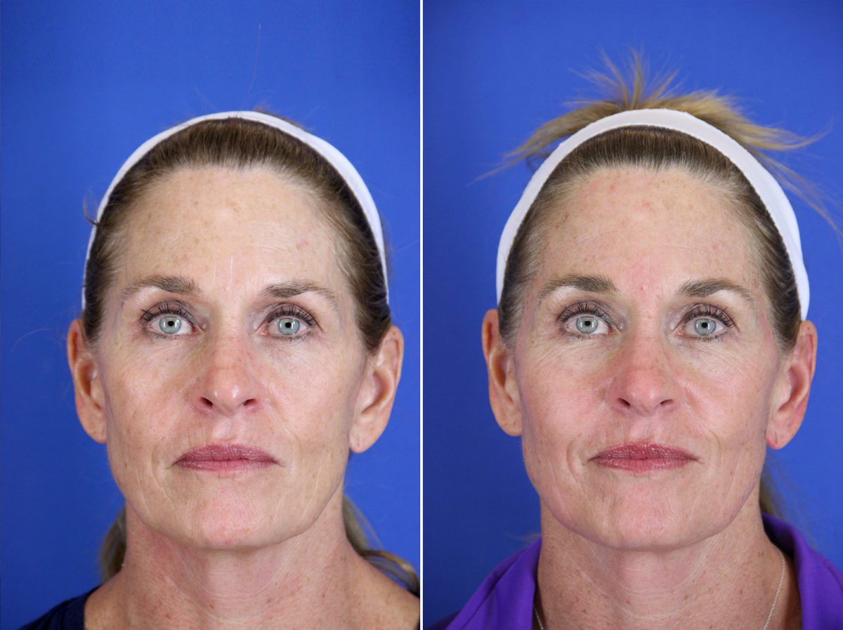 Halo Laser Before and After Photos in Delafield, WI, Patient 17992