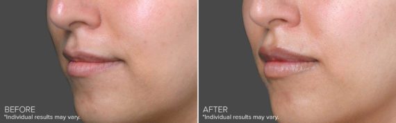 Juvéderm® Before and After Photos in Delafield, WI, Patient 18003