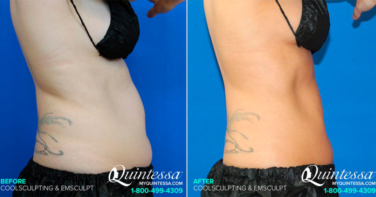 CoolSculpting: Does it work and is it safe?