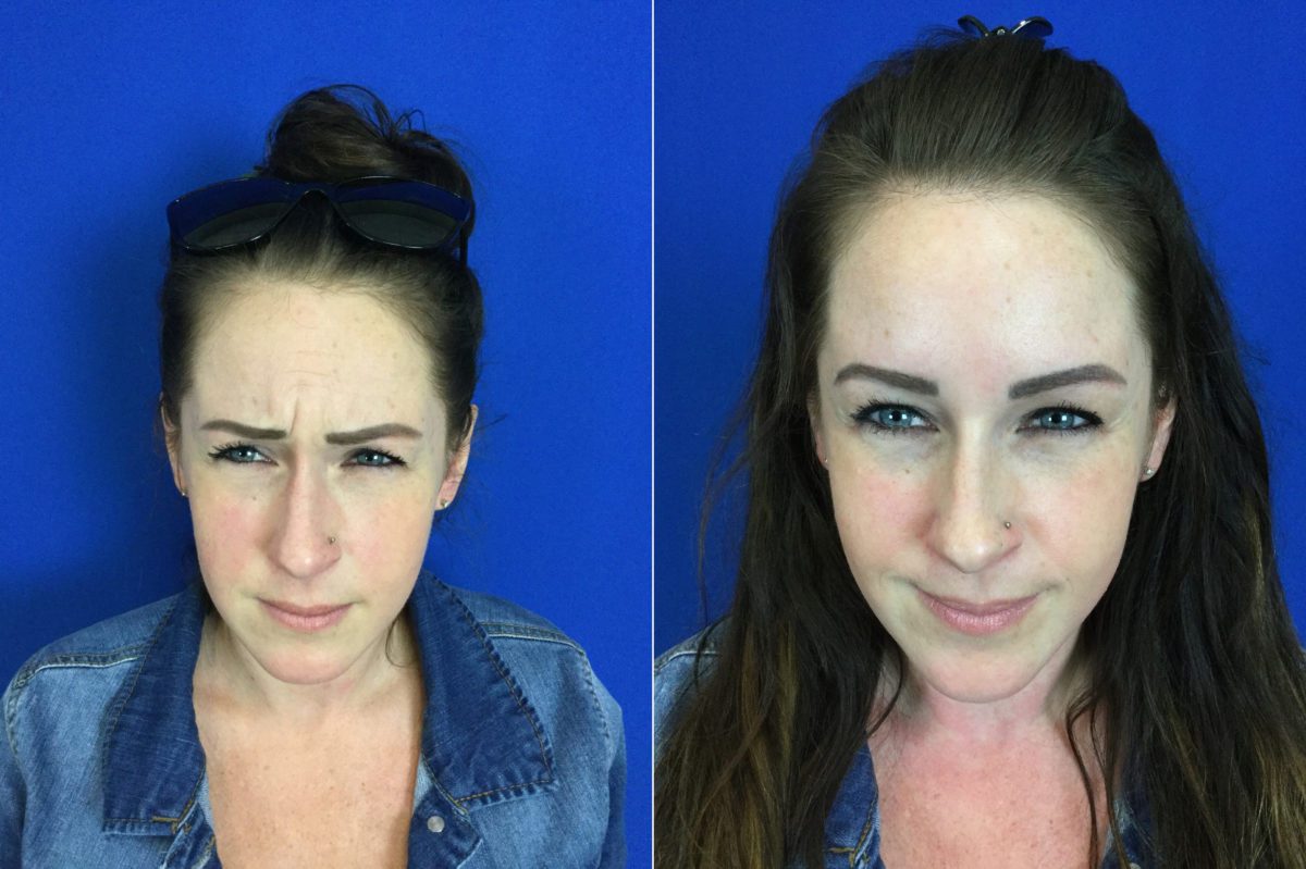 Dysport Before and After Photos in Delafield, WI, Patient 17494