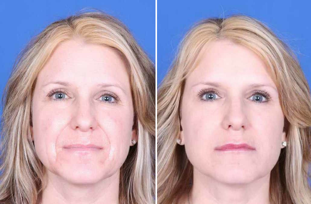 Botox Before and After Photos in , , Patient 19776