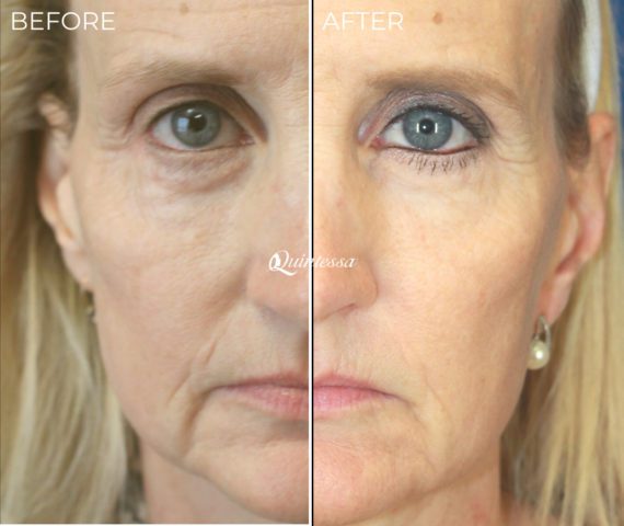 Sculptra® Before and After Photos in , , Patient 19792