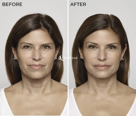 Sculptra® Before and After Photos in , , Patient 19796