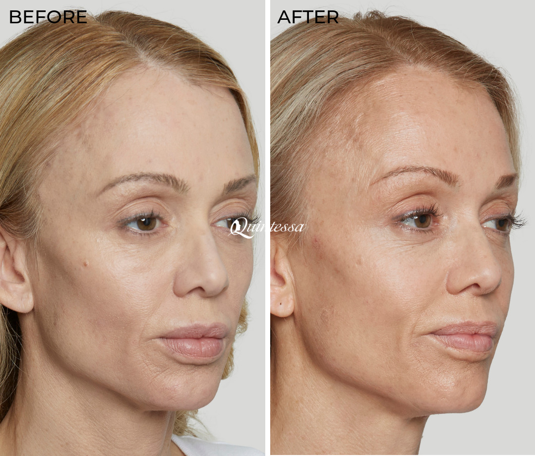 Sculptra® Before and After Photos in , , Patient 19800