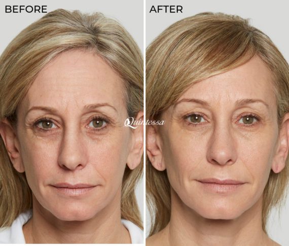 Sculptra® Before and After Photos in Mequon, WI, Patient 19807