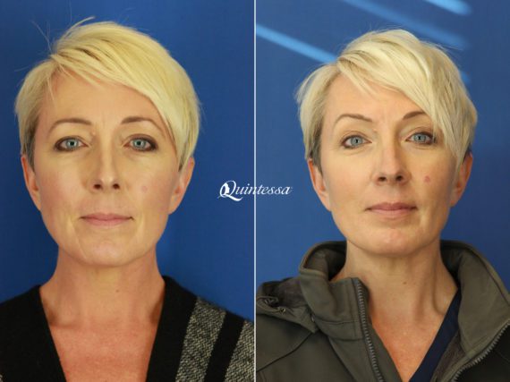 Fillers Before and After Photos in Madison, WI, Patient 19815