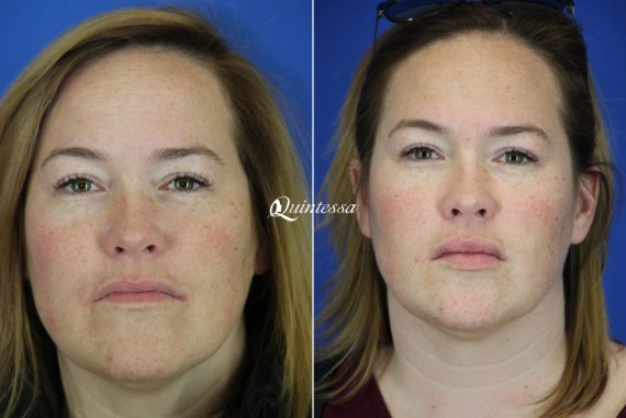 Fillers Before and After Photos in Middleton, WI, Patient 19823