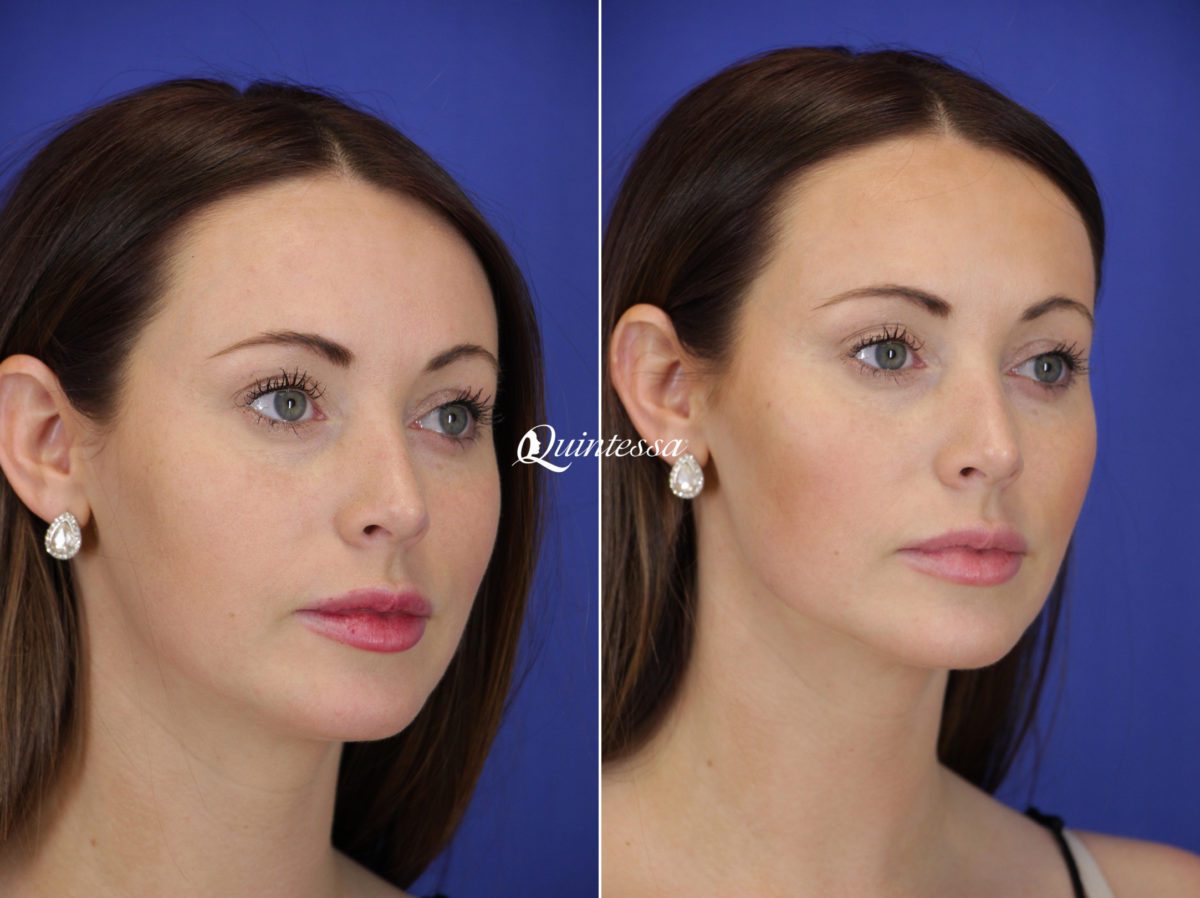 Fillers Before and After Photos in Mequon, WI, Patient 19827