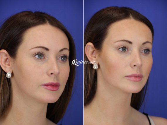 Fillers Before and After Photos in Mequon, WI, Patient 19827