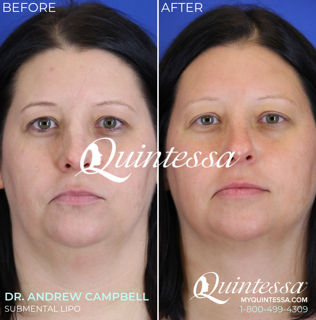 Liposuction Before and After Photos in Delafield, WI, Patient 19843