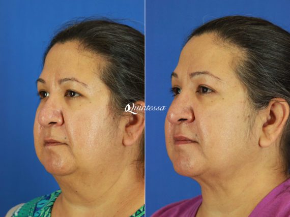 Chin Augmentation Before and After Photos in , , Patient 19853