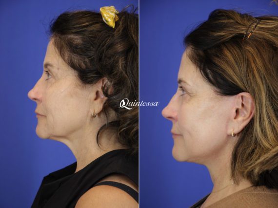 Mini Facelift Before and After Photos in , , Patient 19858