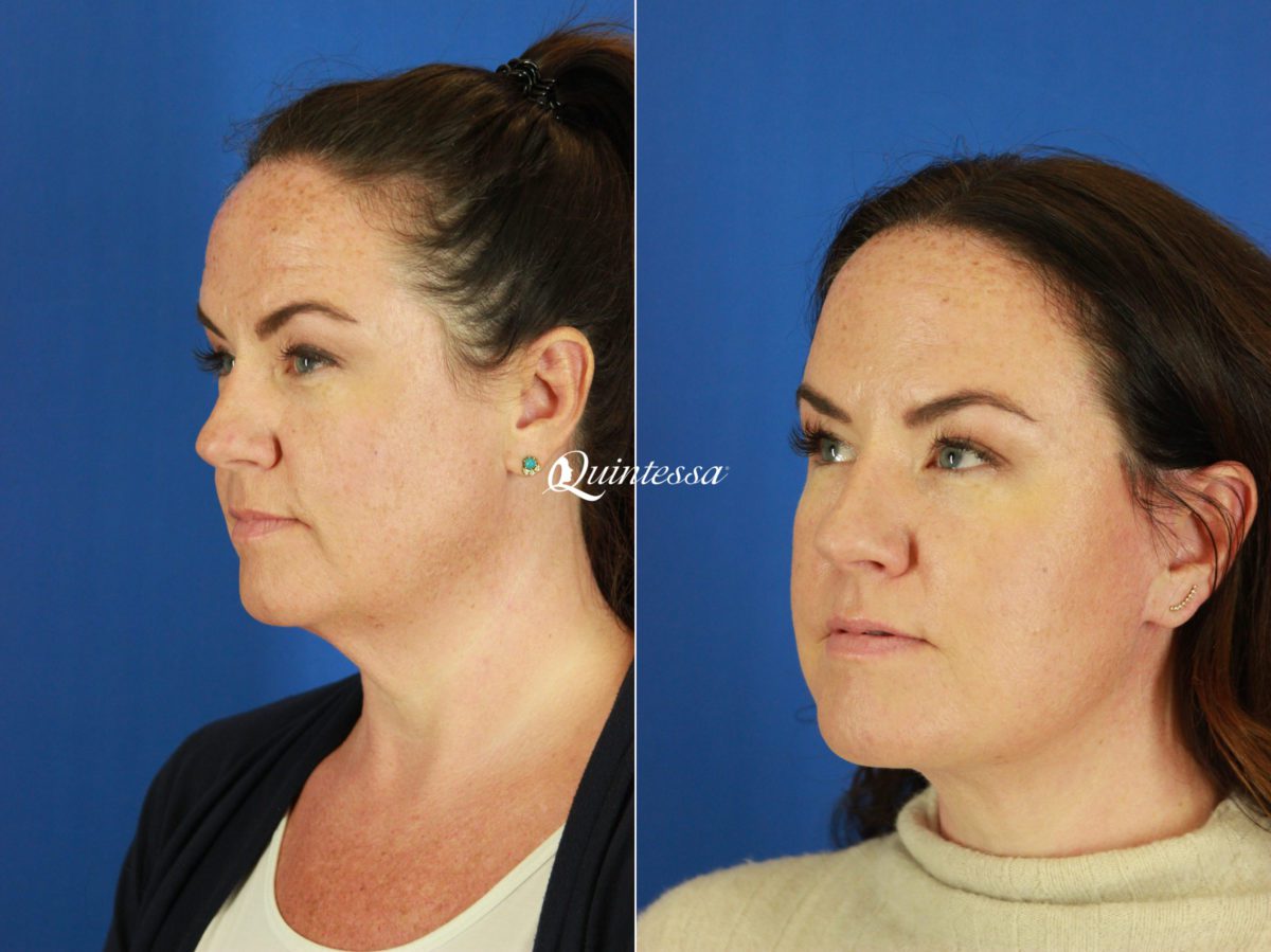 Mini Facelift Before and After Photos in , , Patient 19862